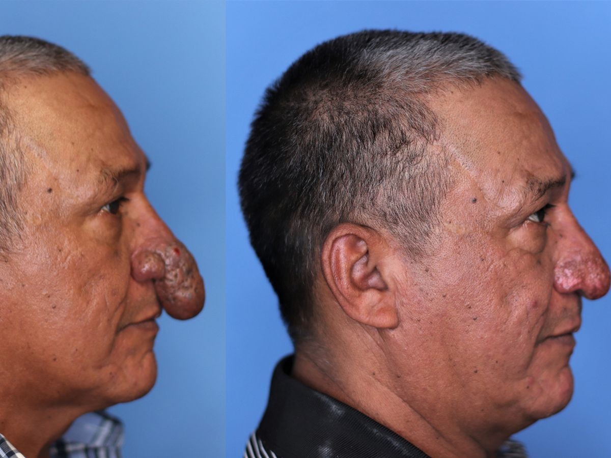 0_Man-with-severely-deformed-nose-who-was-forced-to-wear-face-masks-to-hid-it-gets-miracle-surgery-for.jpg